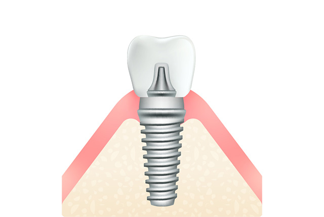 インプラント治療