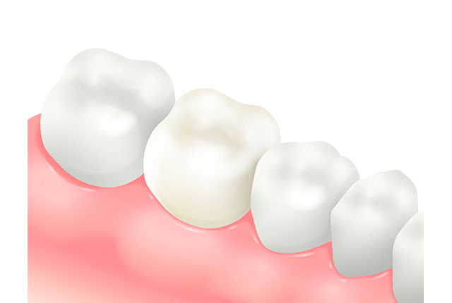 セラミッククラウン