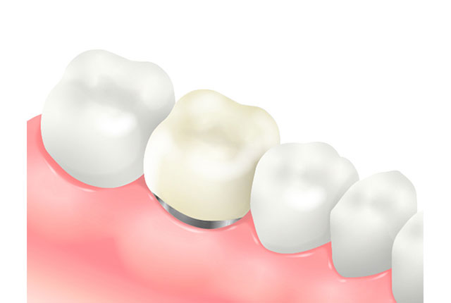 メタルボンドクラウン